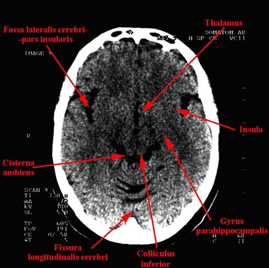 tomografia komputerowa głowy - 08b.jpg